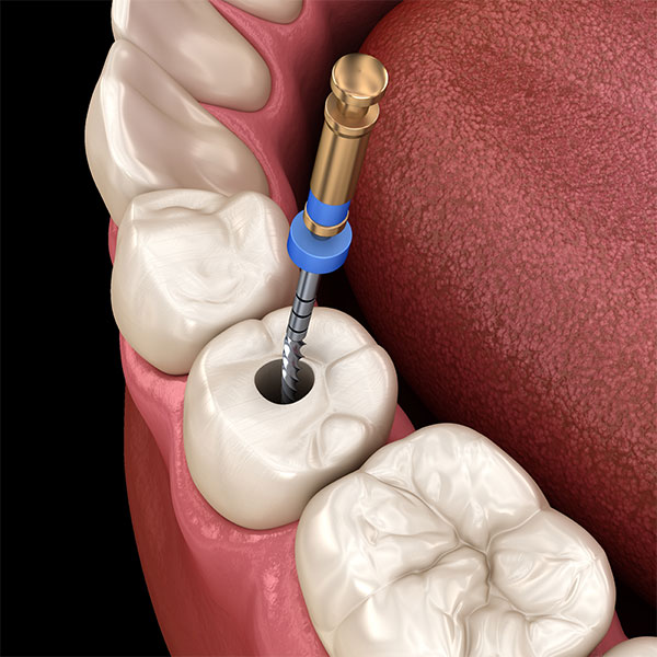 Root Canals